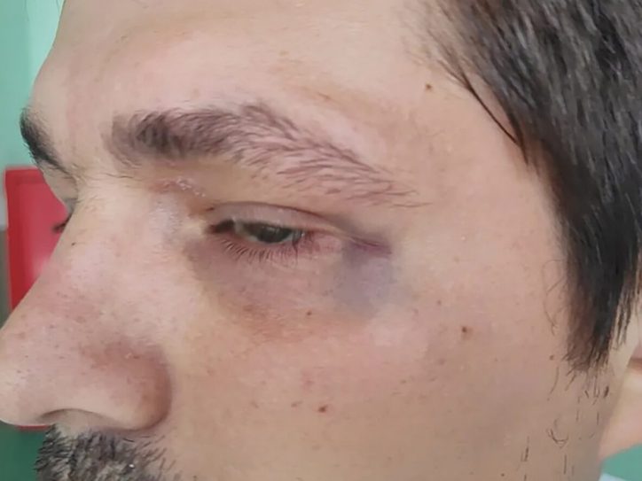 Napadnuti aktivista Aleksa Pavlović